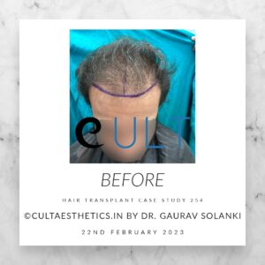 Hair Transplant Case 254 - Before Treatment at Cult Aesthetics Gurgaon