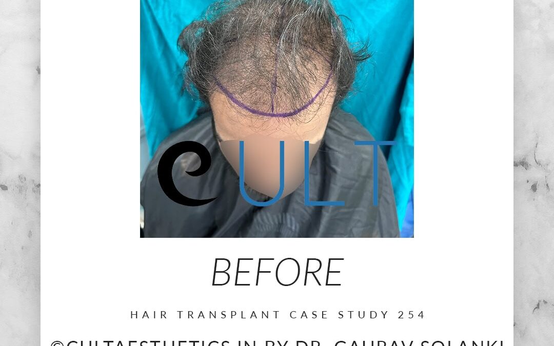 Case 254 Before 2