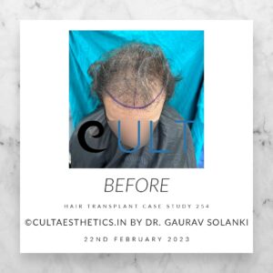 Hair Transplant Case 254 - Before Treatment at Cult Aesthetics Gurgaon