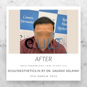 Hair Transplant Case 255 - After Results at Cult Aesthetics Gurgaon