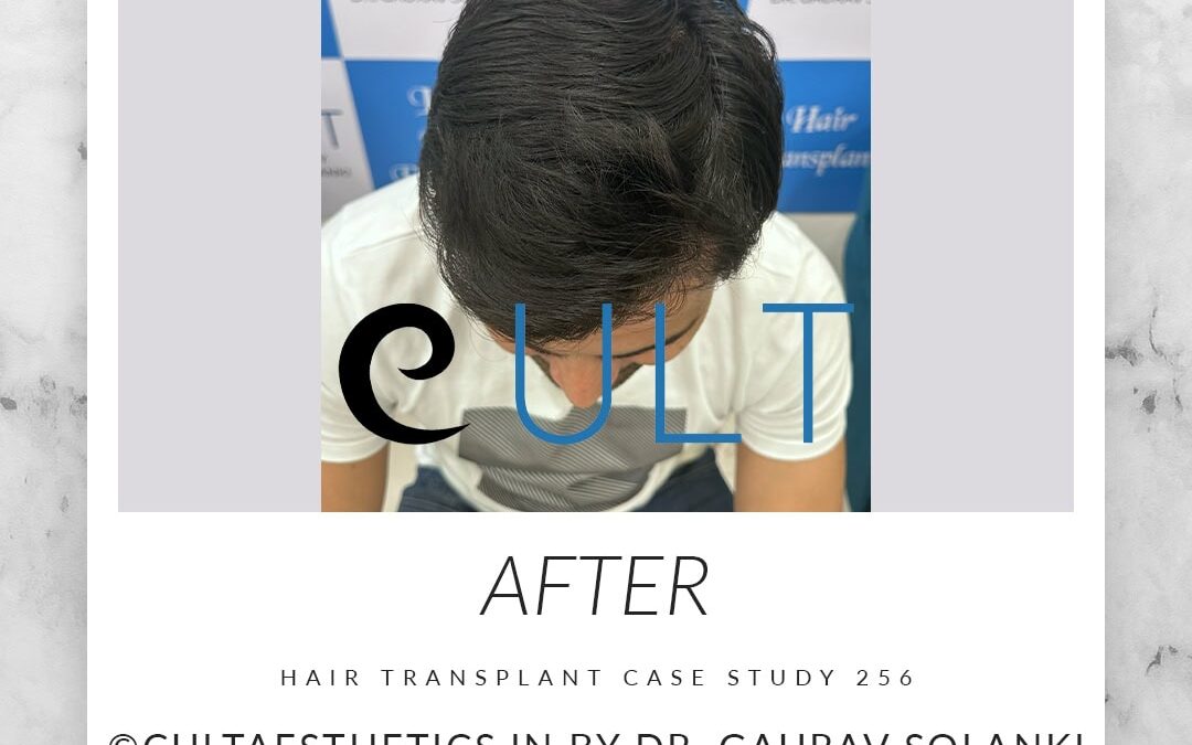 Case 256 After 4