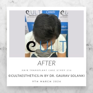 Hair Transplant Case 256 - After Results at Cult Aesthetics Gurgaon