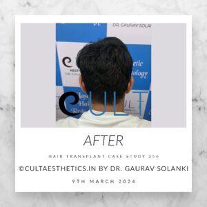 Hair Transplant Case 256 - After Results at Cult Aesthetics Gurgaon