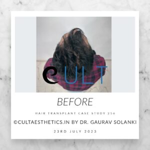 Hair Transplant Case 256 - Before Treatment at Cult Aesthetics Gurgaon