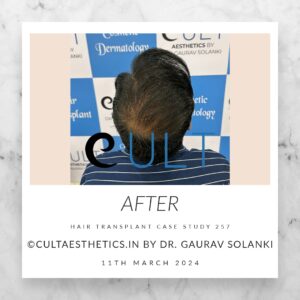 Hair Transplant Case 257 - After Results at Cult Aesthetics Gurgaon