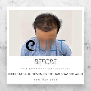 Hair Transplant Case 257 - Before Treatment at Cult Aesthetics Gurgaon