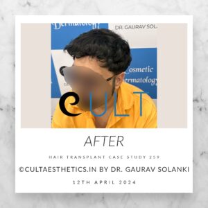 Hair Transplant Case 259 - After Results at Cult Aesthetics Gurgaon
