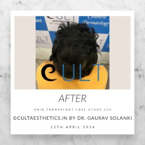 Hair Transplant Case 259 - After Results at Cult Aesthetics Gurgaon