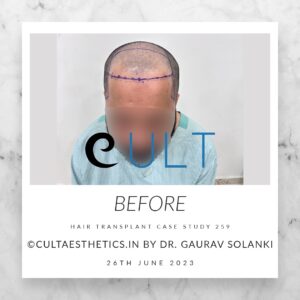 Hair Transplant Case 259 - Before Treatment at Cult Aesthetics Gurgaon