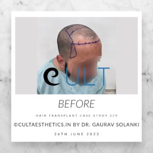 Hair Transplant Case 259 - Before Treatment at Cult Aesthetics Gurgaon