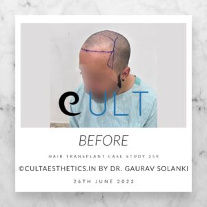 Hair Transplant Case 259 - Before Treatment at Cult Aesthetics Gurgaon