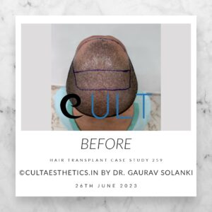 Hair Transplant Case 259 - Before Treatment at Cult Aesthetics Gurgaon