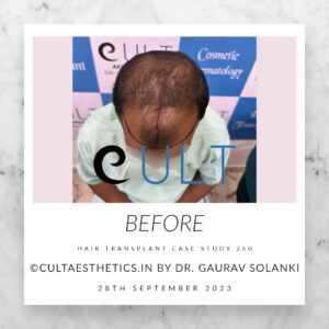 Hair Transplant Case 260 - Before Treatment at Cult Aesthetics Gurgaon