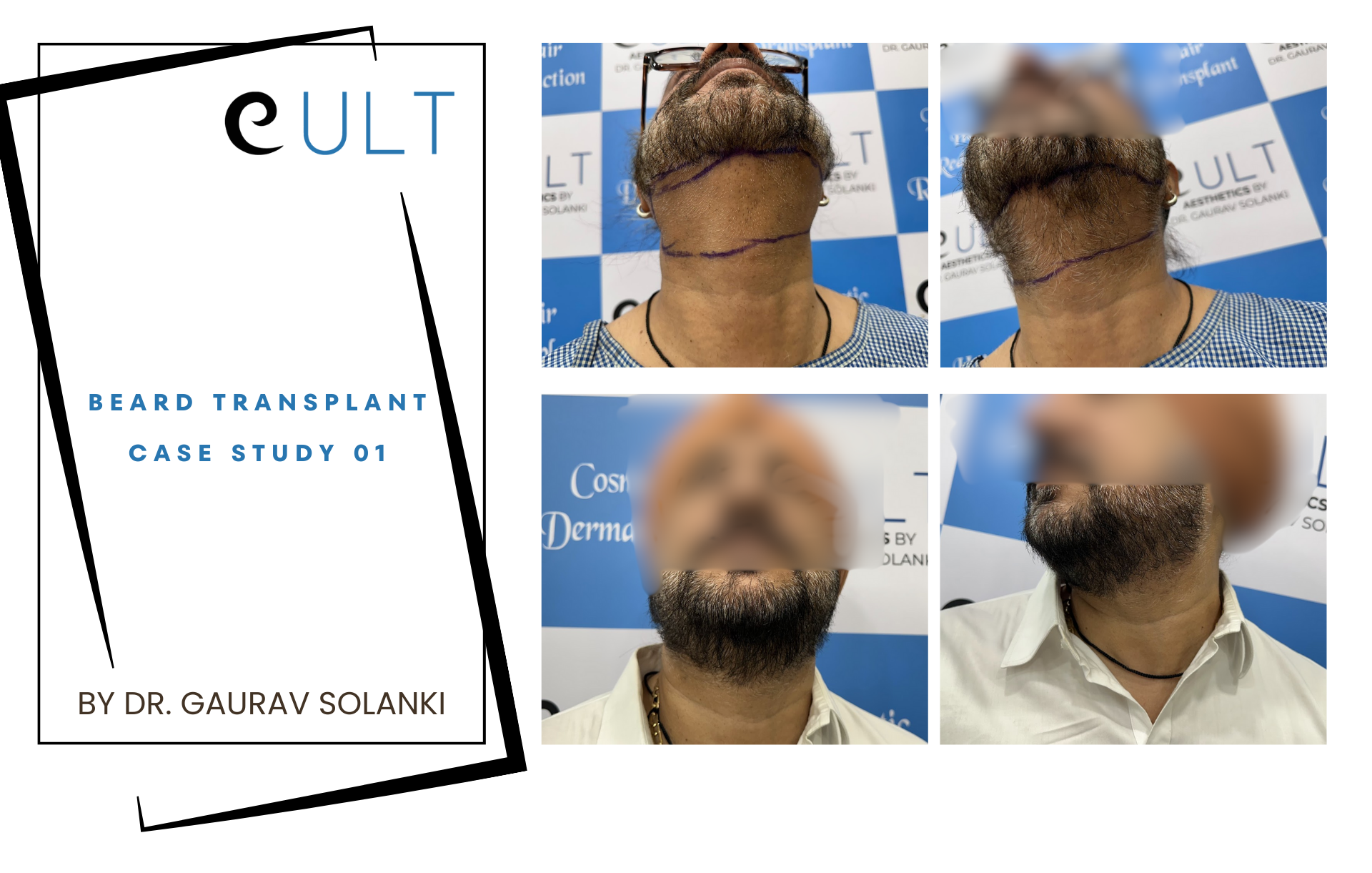 Beard Transplant case 01