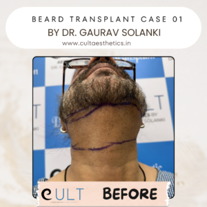 Before 1 - Hair Transplant Clinic in Gurgaon