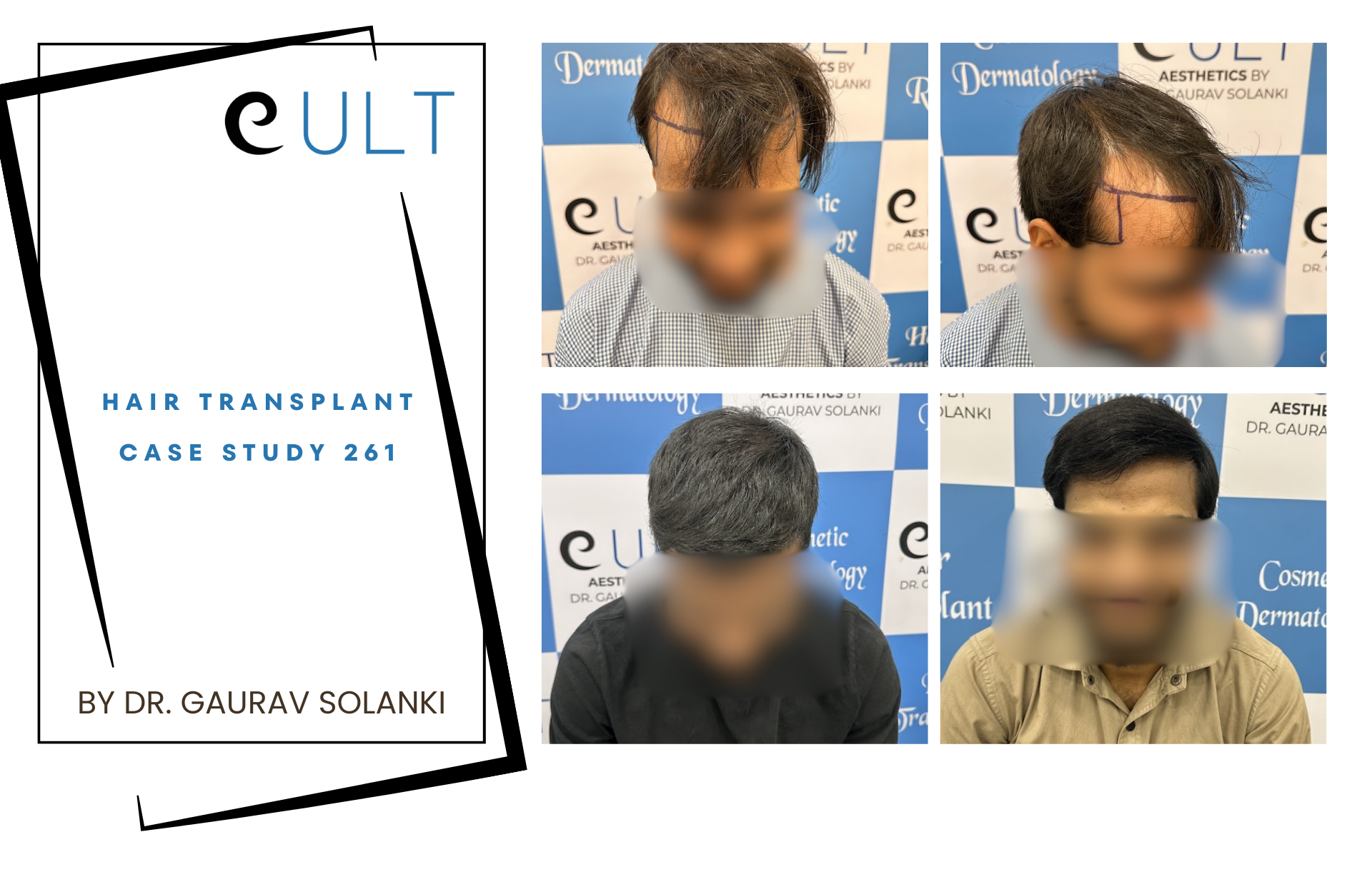 Hair Transplant case 261 banner