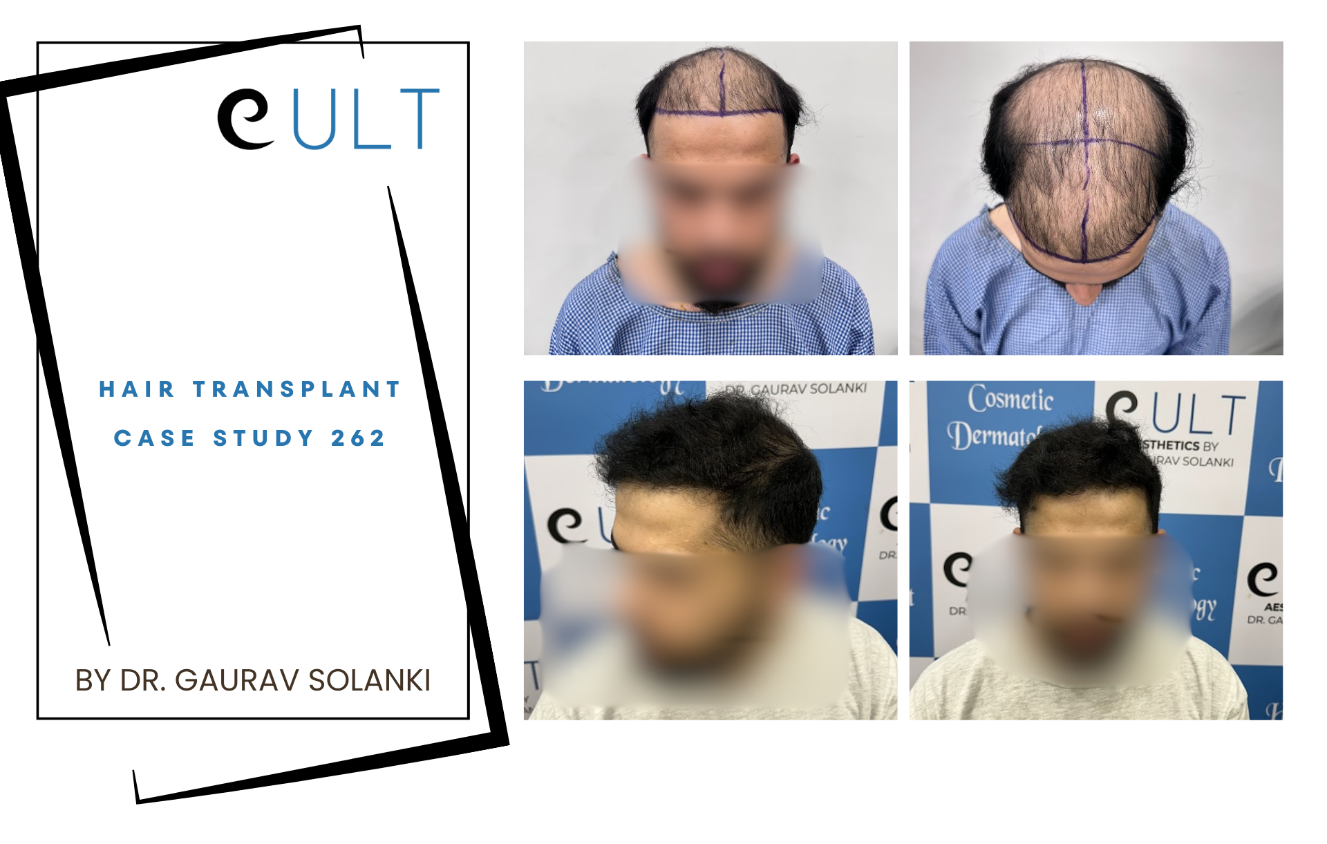 Hair Transplant case 262