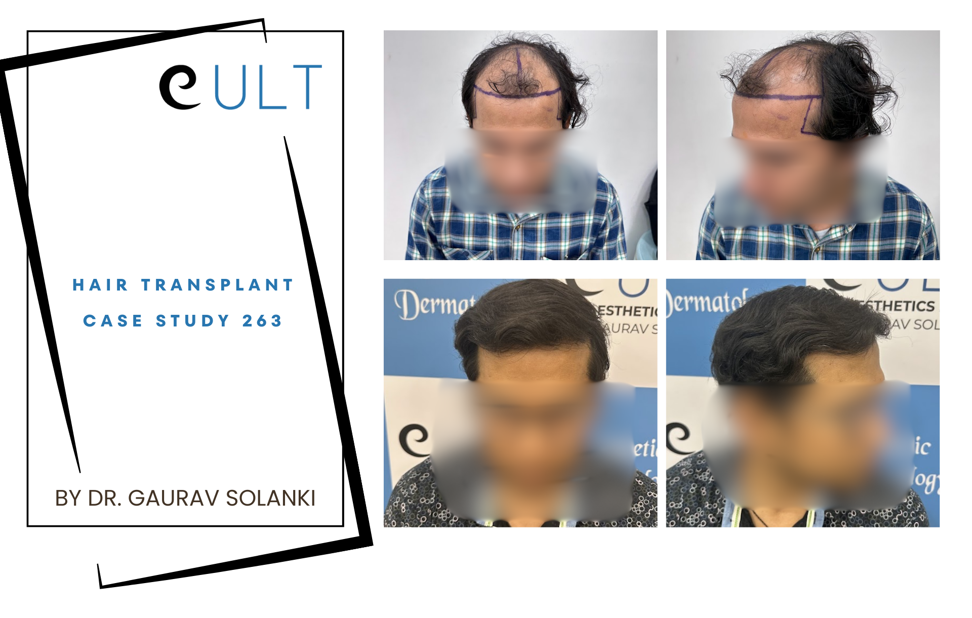 Hair Transplant case 263
