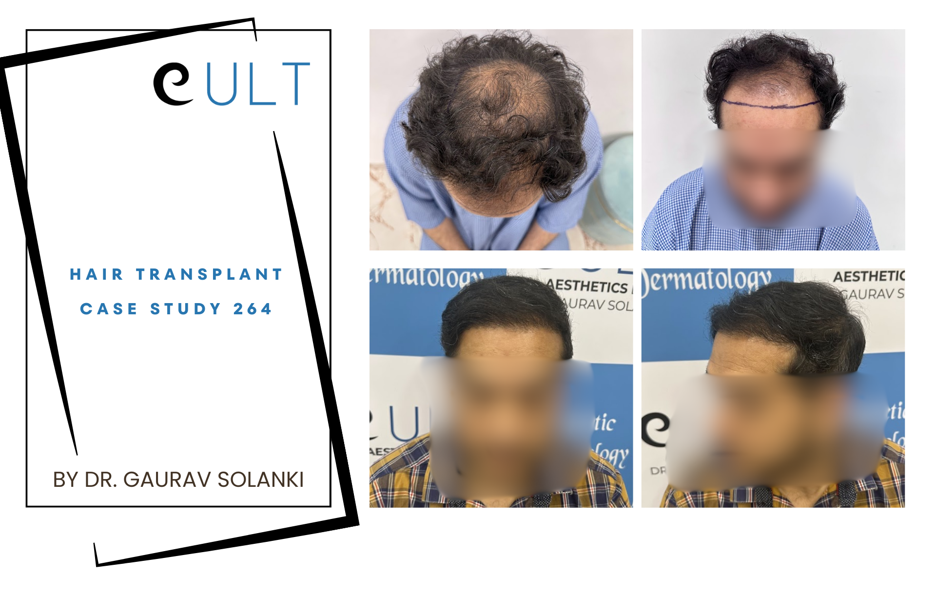 Hair Transplant case 264