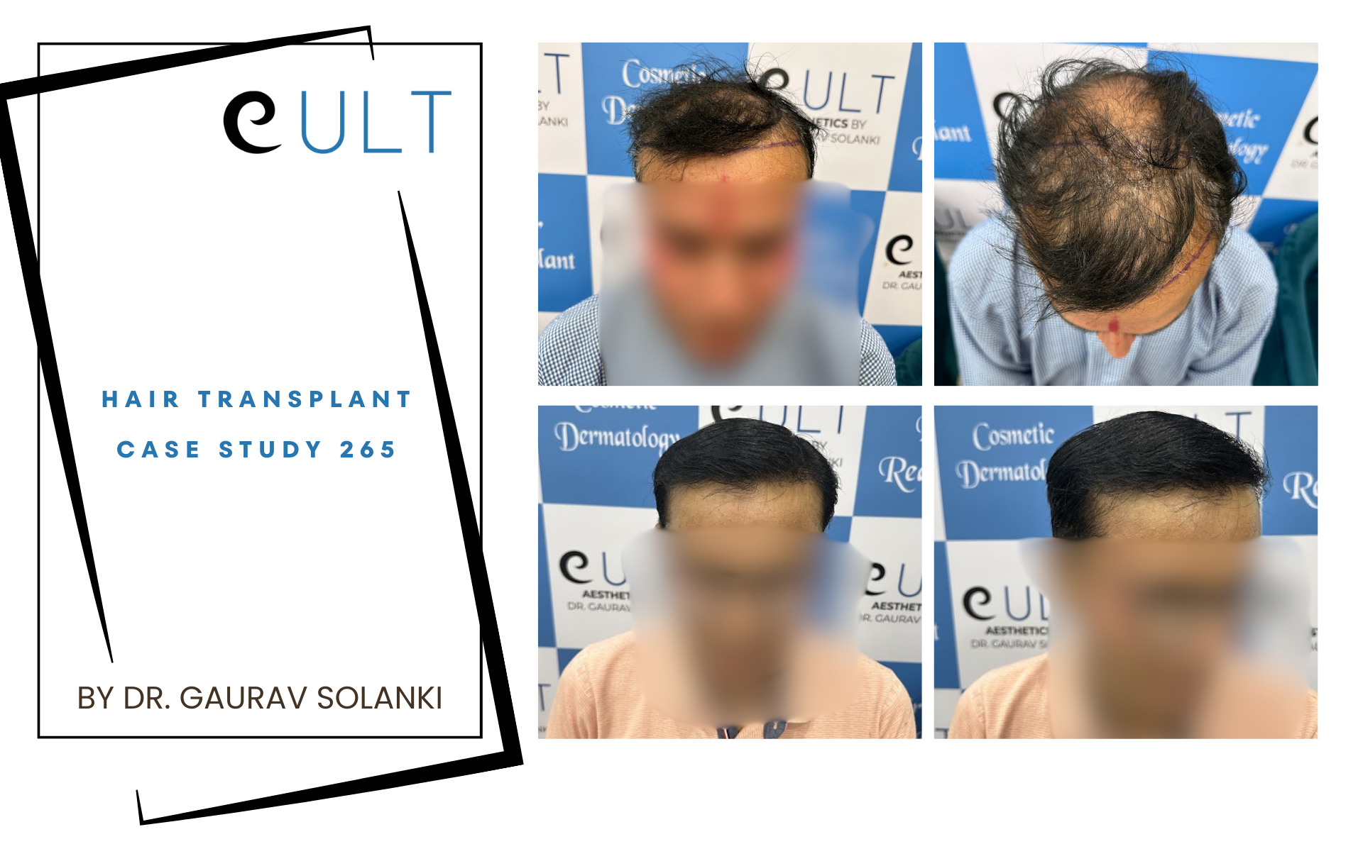 Hair Transplant case 265
