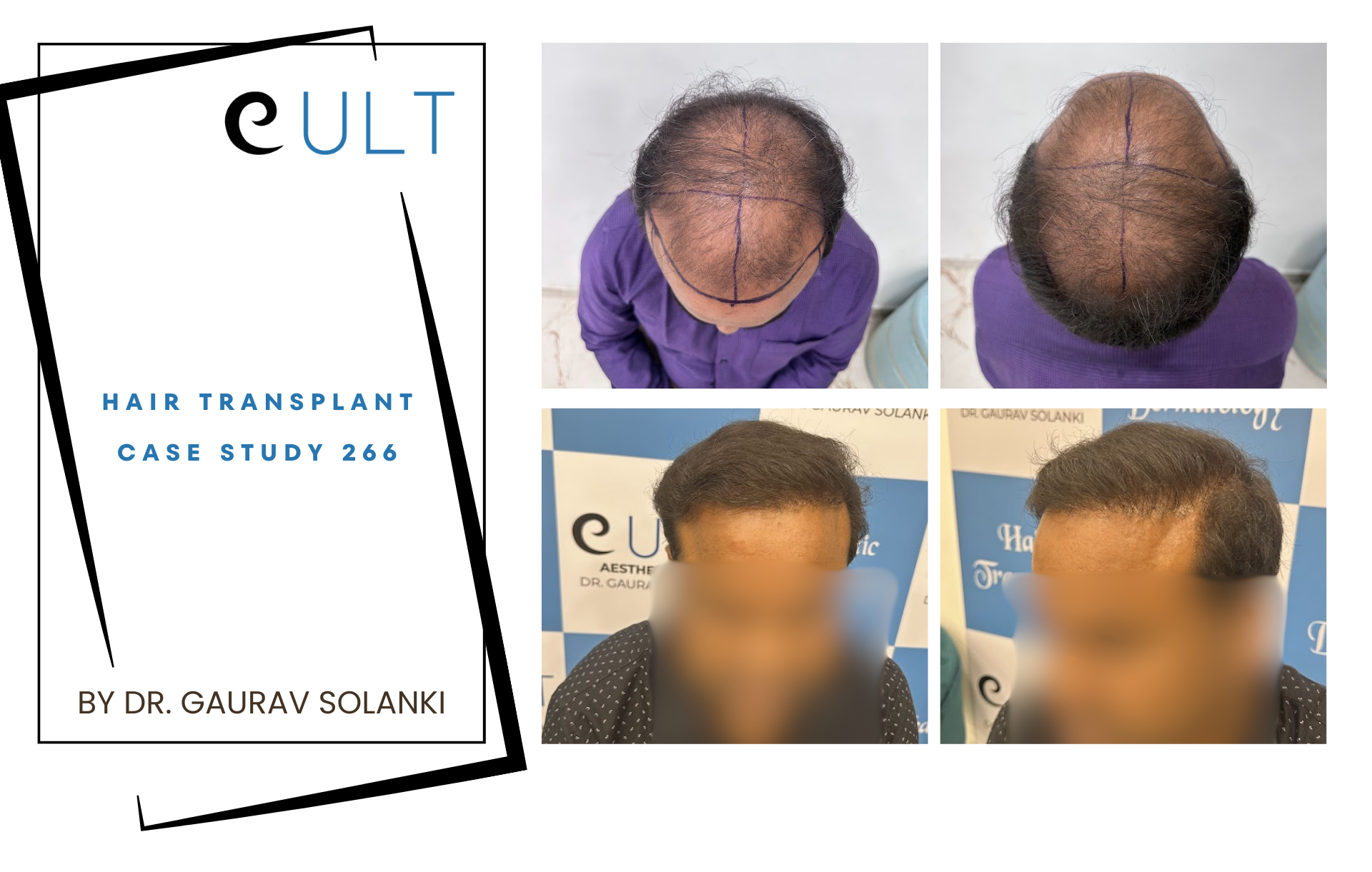 Hair Transplant case 266