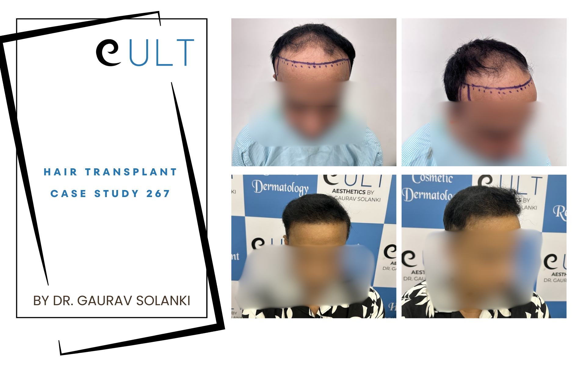 Hair Transplant case 267