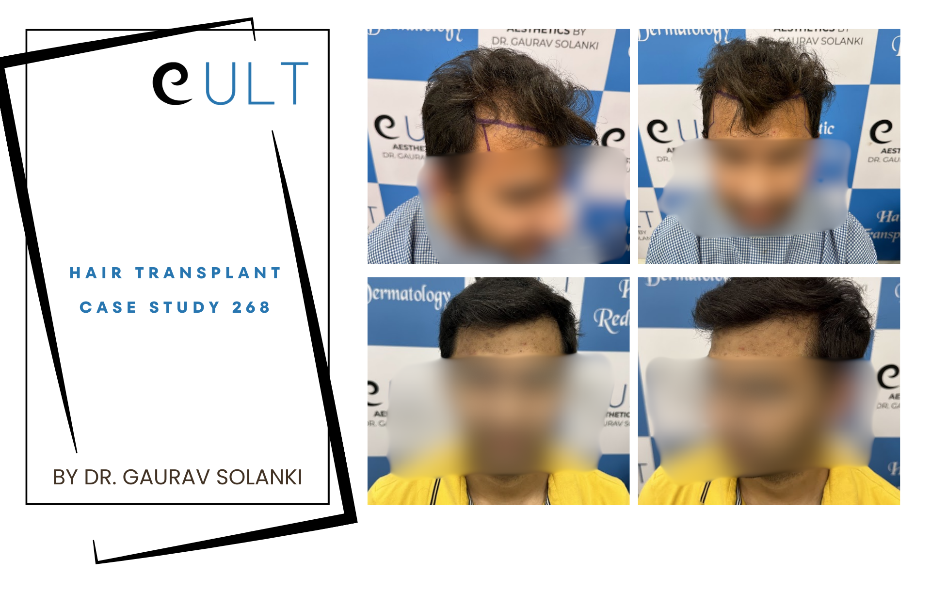 Hair Transplant case 268
