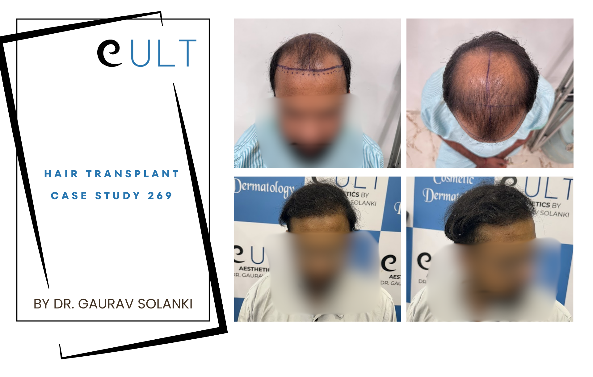 Hair Transplant case 269