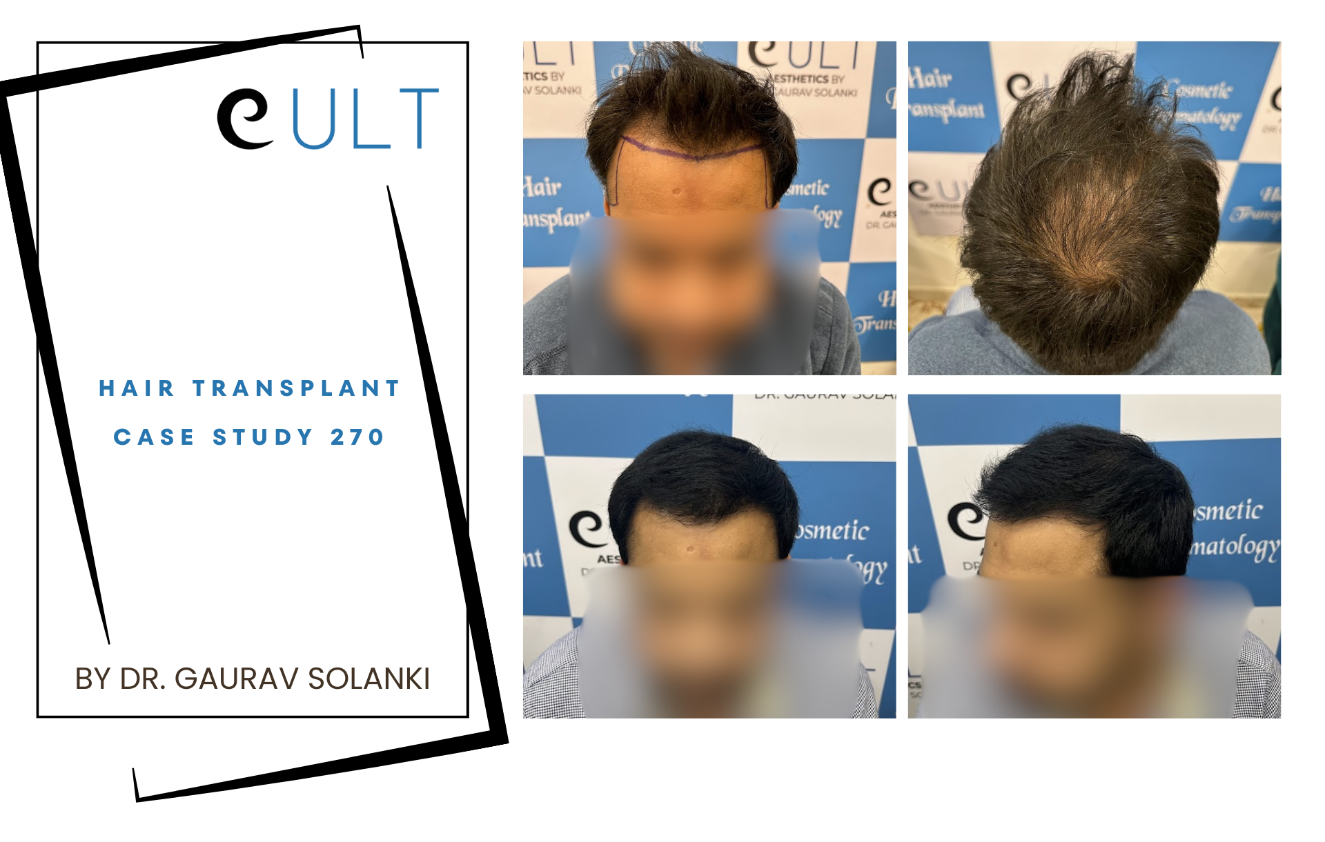 Hair Transplant case 270