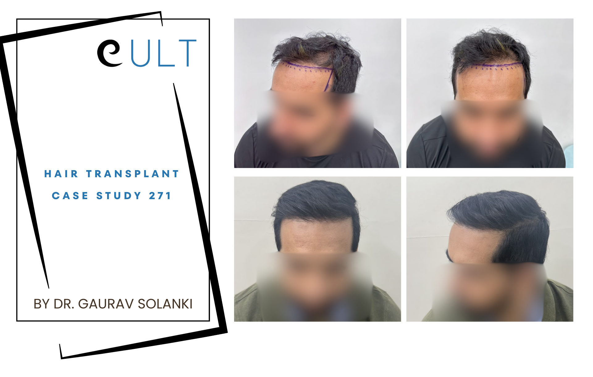 Hair Transplant case 271