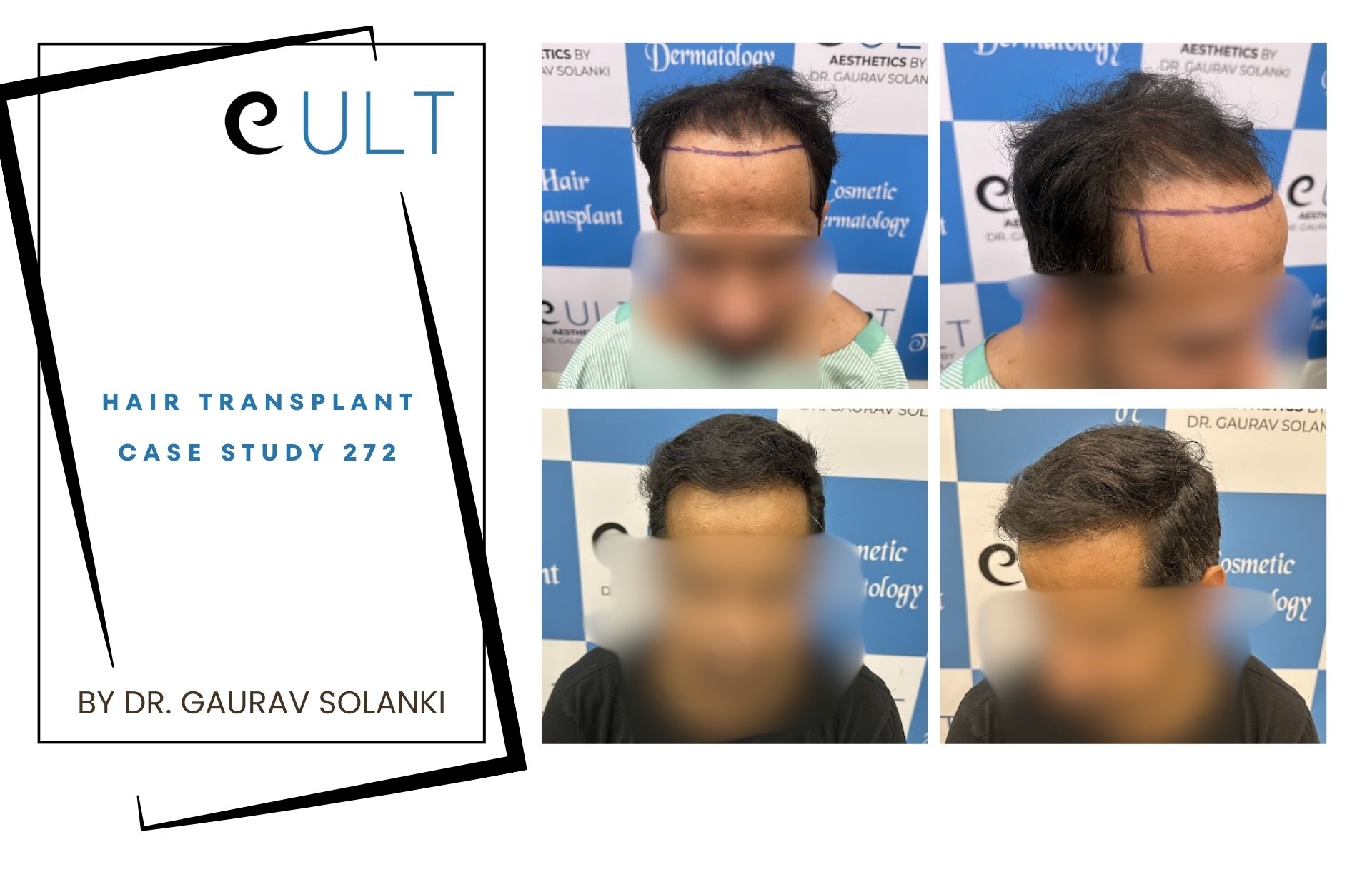 Hair Transplant case 272