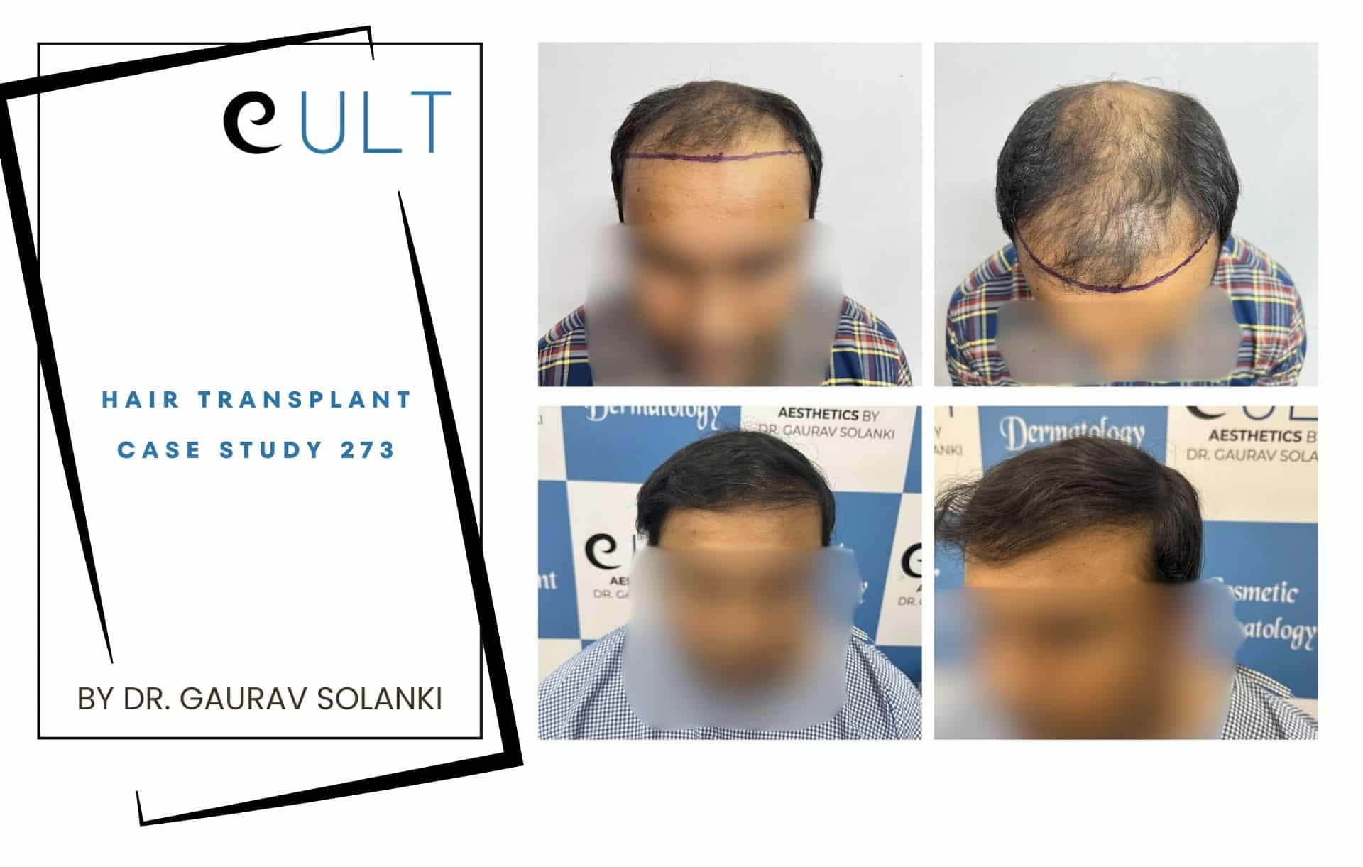 Hair Transplant case 273
