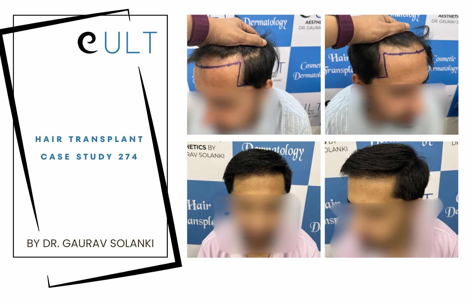 Hair Transplant case 274