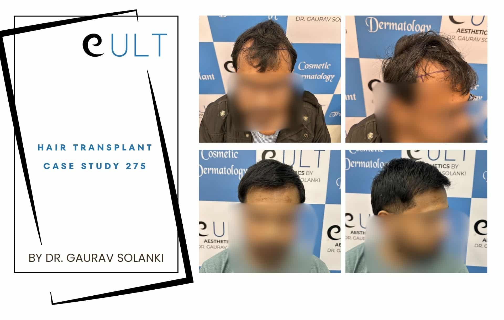 Hair Transplant case 275