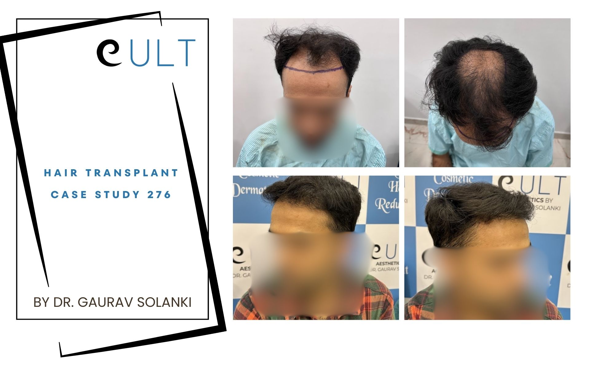 Hair Transplant case 276