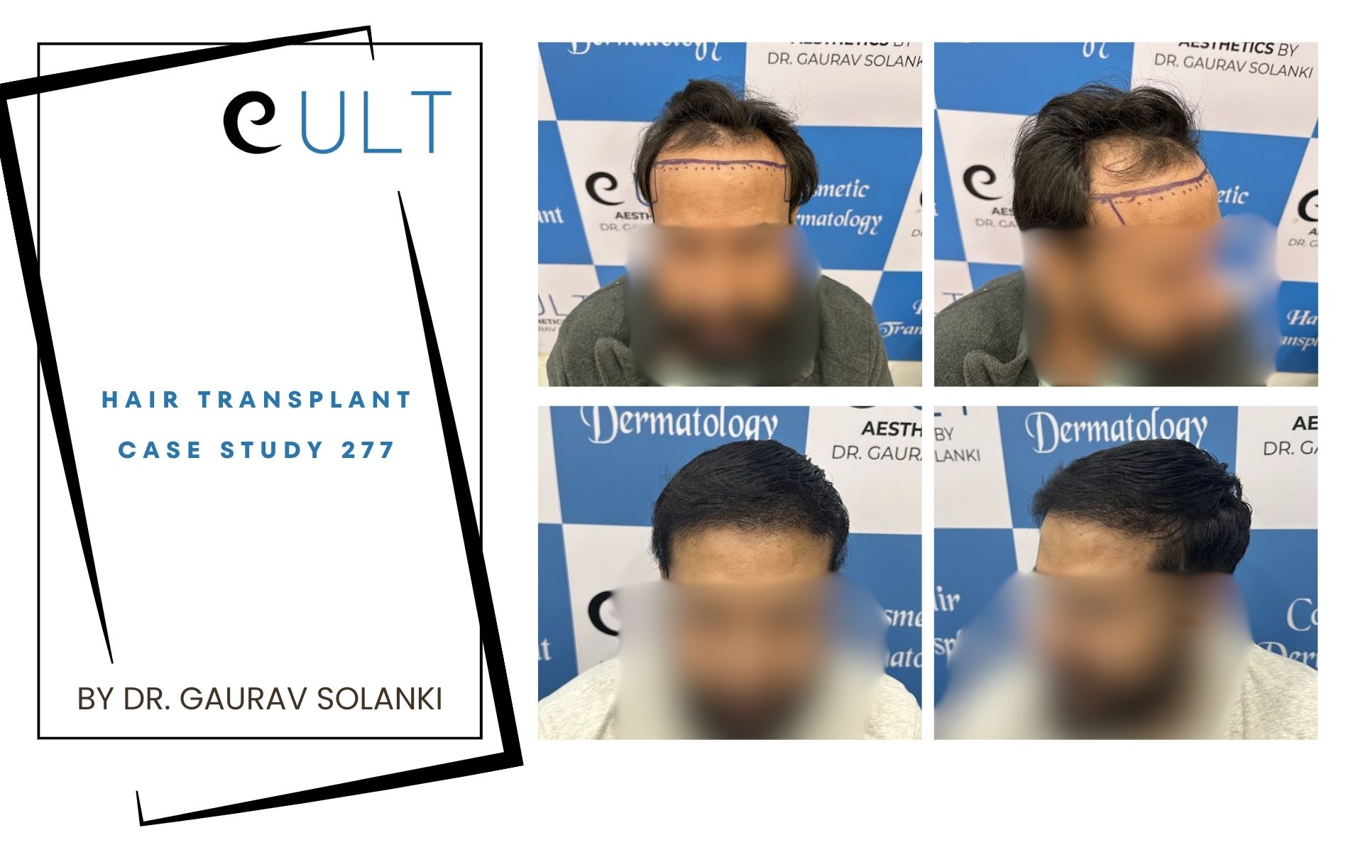 Hair Transplant case 277