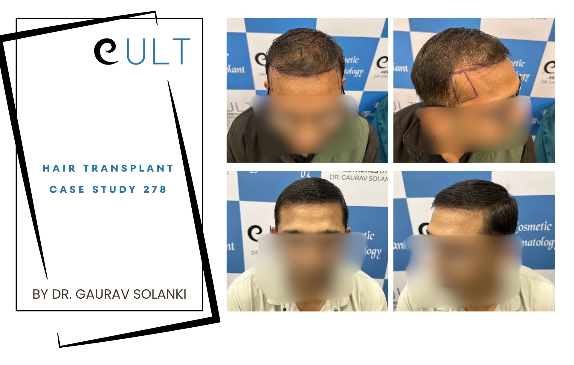 Hair Transplant case 278