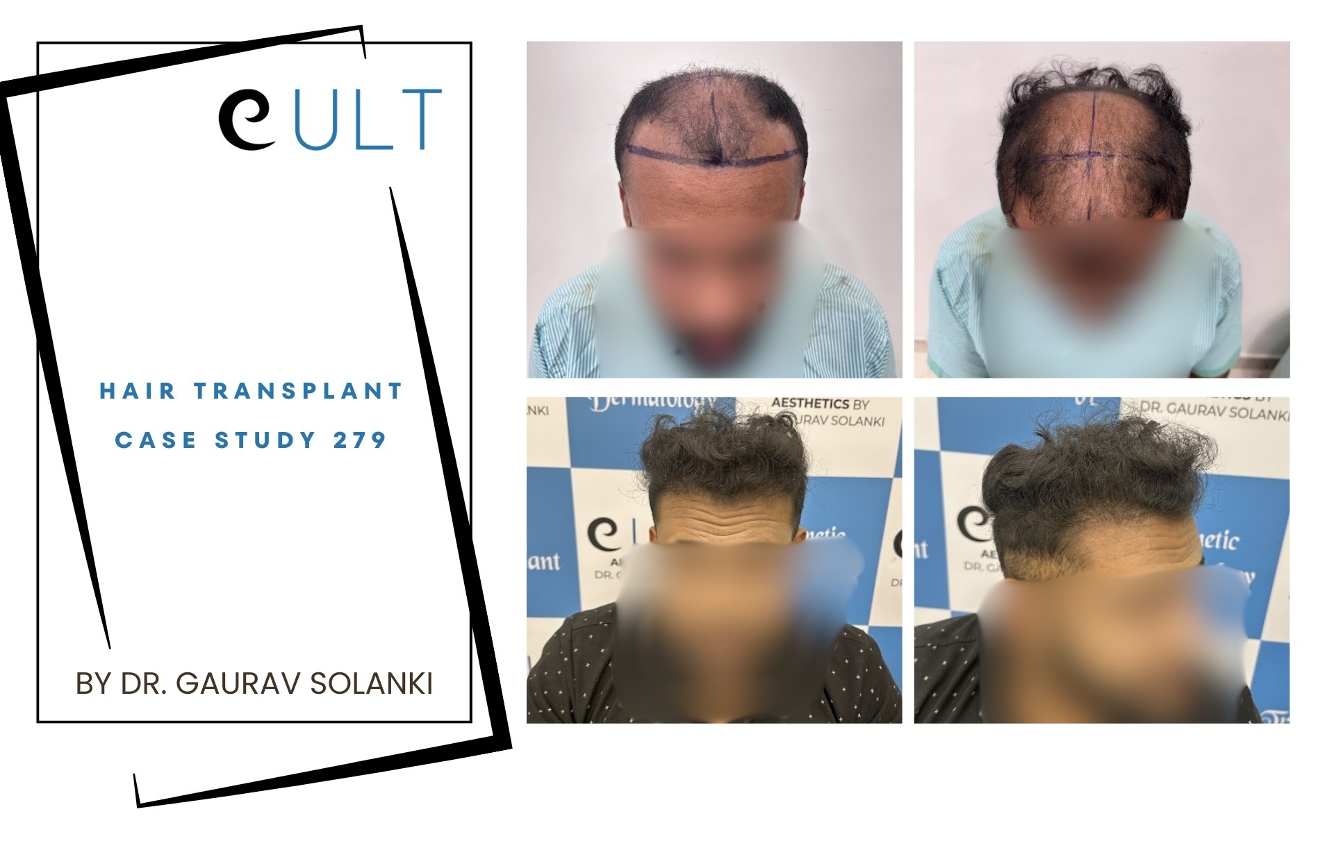 Hair Transplant case 279