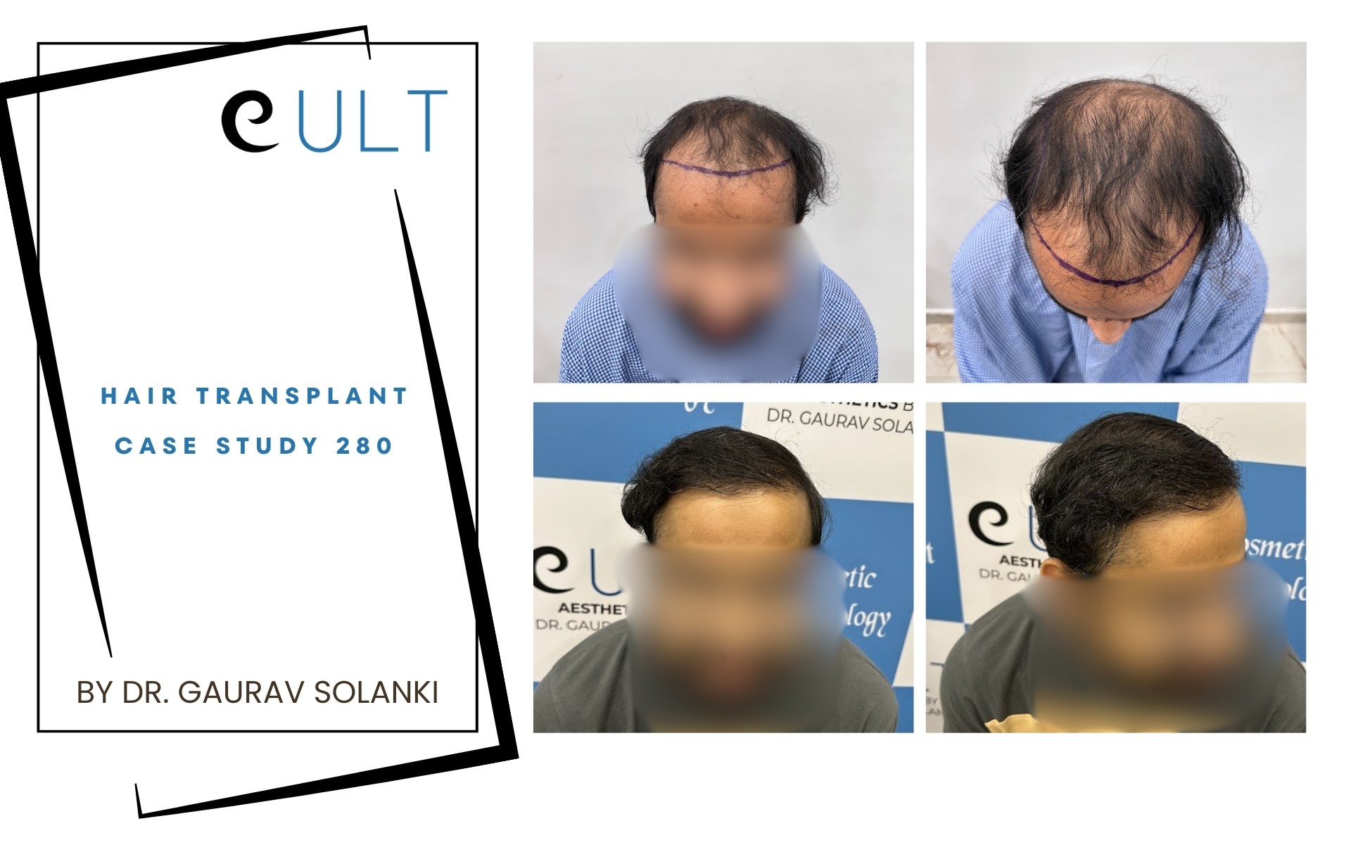 Hair Transplant case 280