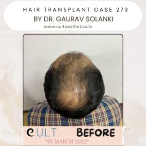 Hair Transplant Case 273 - Before Treatment at Cult Aesthetics Gurgaon