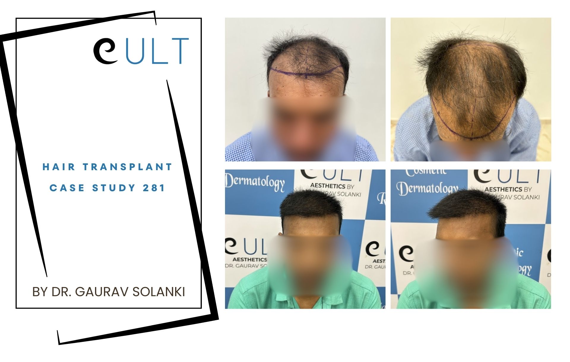 Hair Transplant case 281