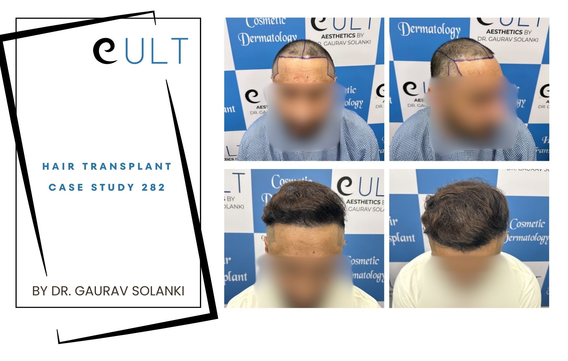 Hair Transplant case 282