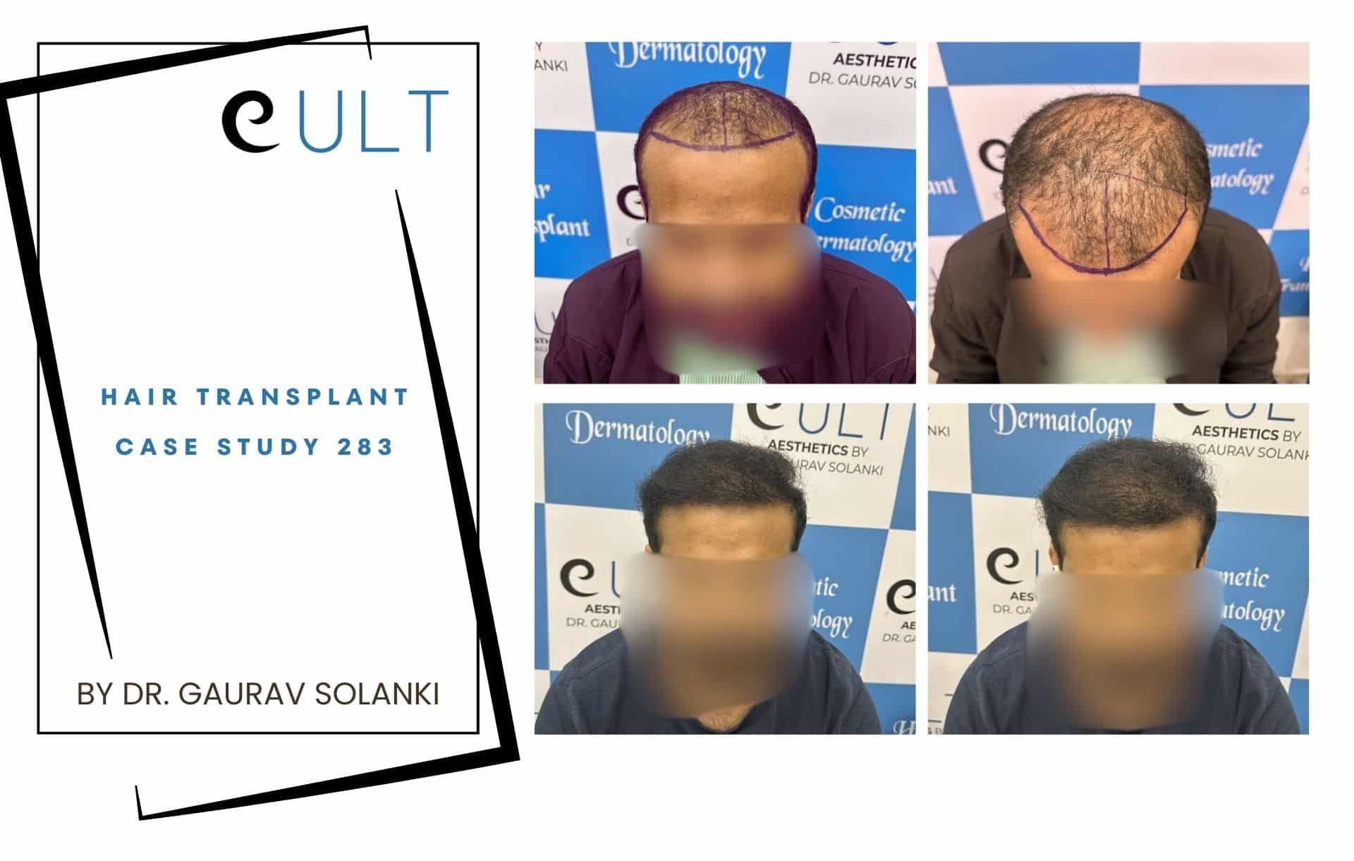 Hair Transplant case 283