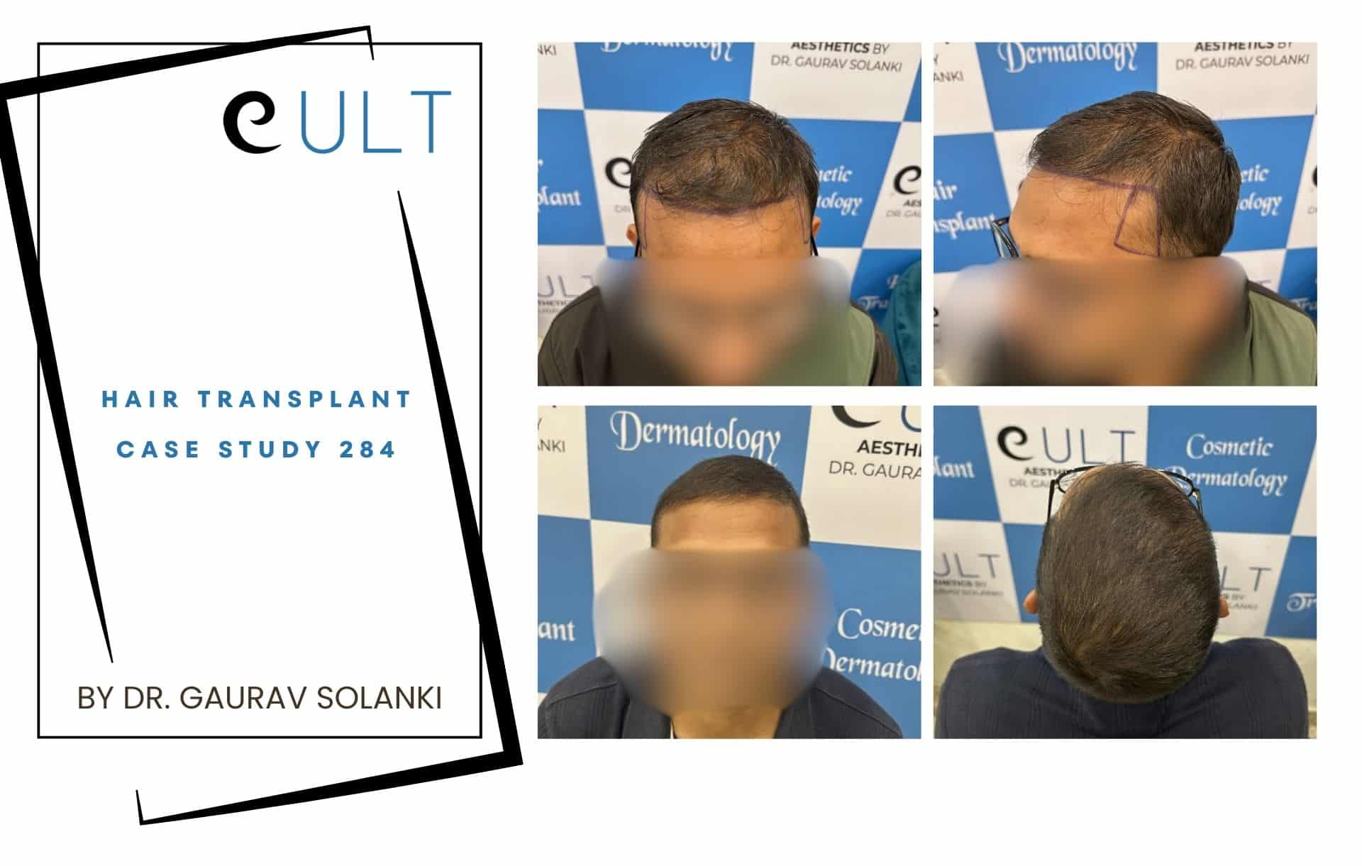 Hair Transplant case 284