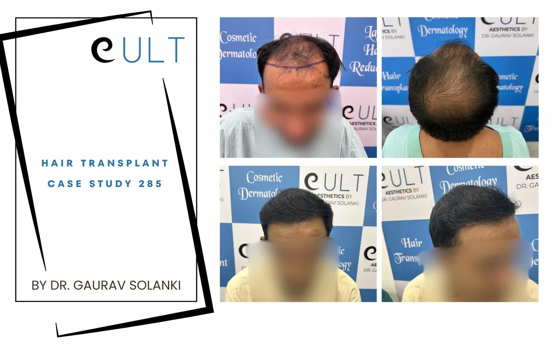 Hair Transplant case 285