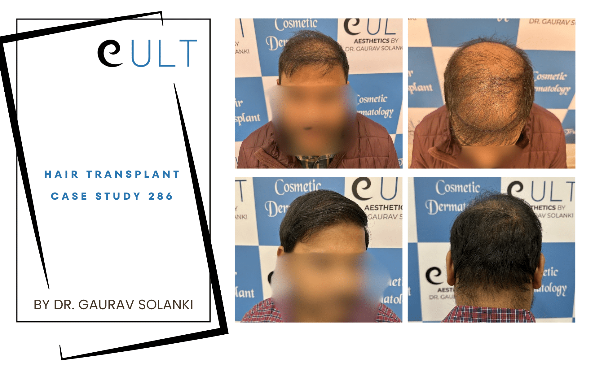 Hair Transplant case 286