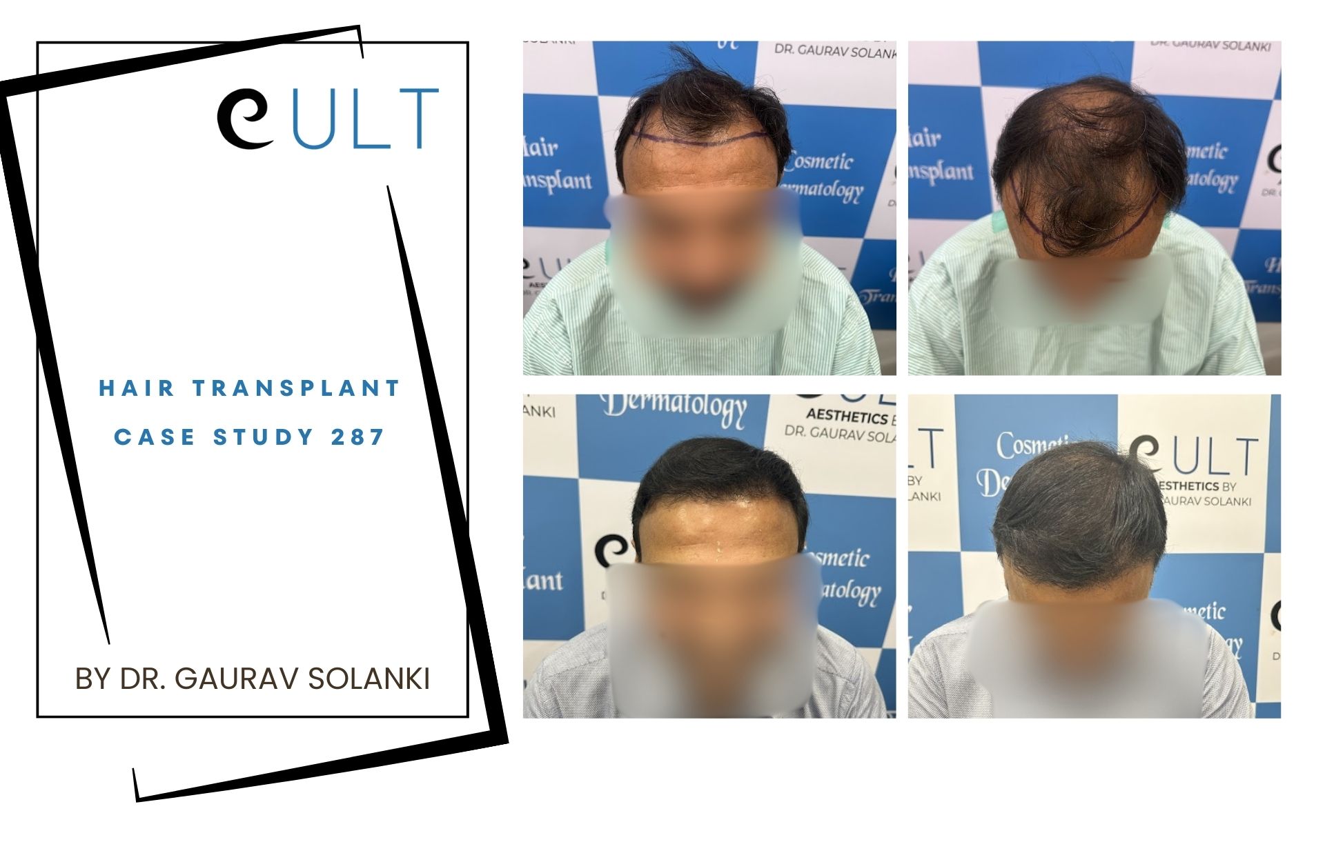 Hair Transplant case 287