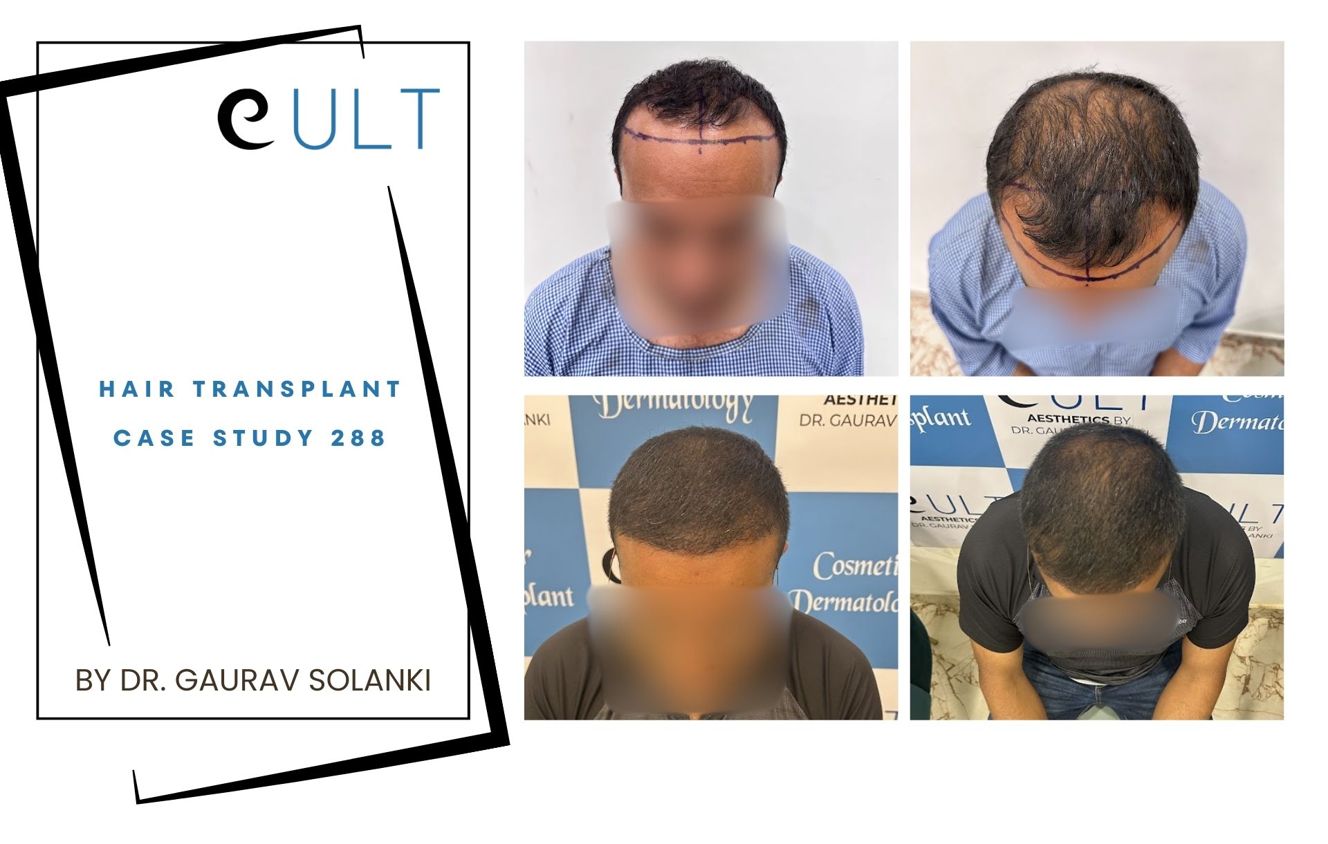 Hair Transplant case 288