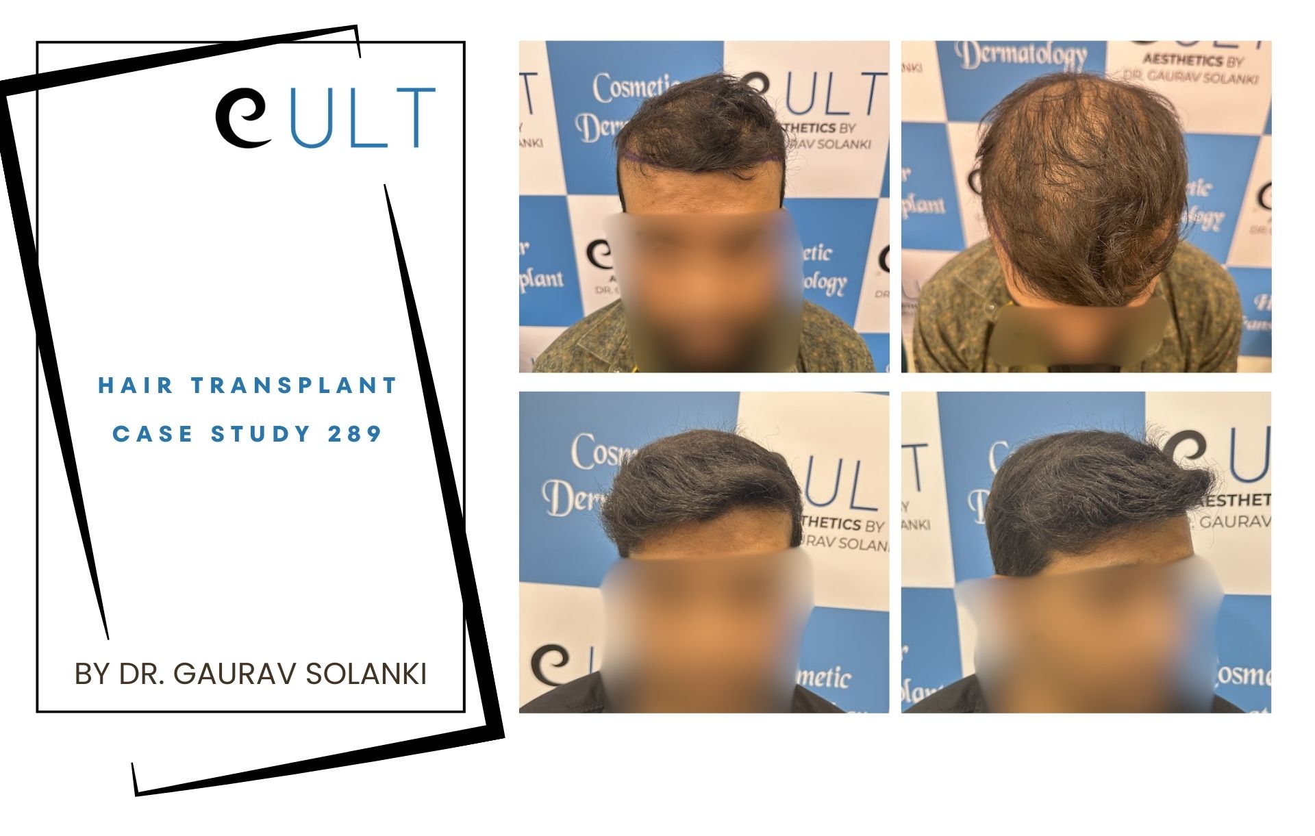 Hair Transplant case 289