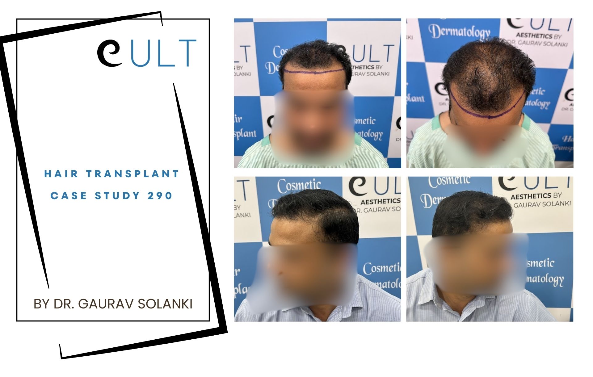 Hair Transplant case 290